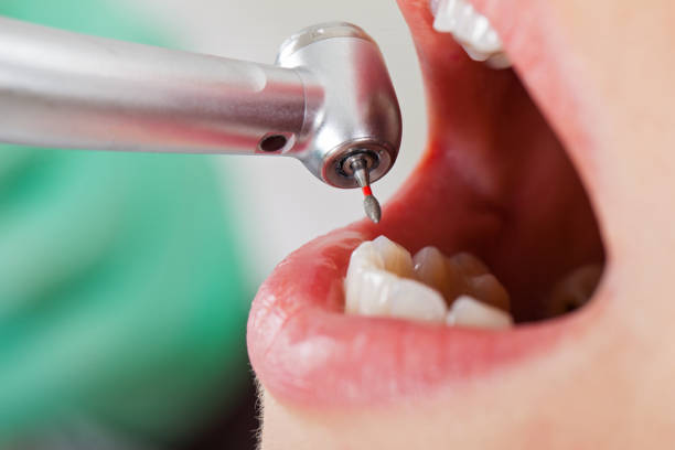 Best Emergency Root Canal Treatment in Lordstown, OH